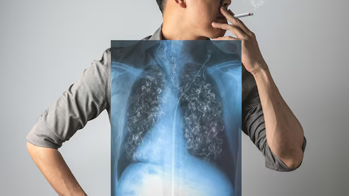 10 Kebiasaan Merokok yang Bisa Memicu Kanker Paru